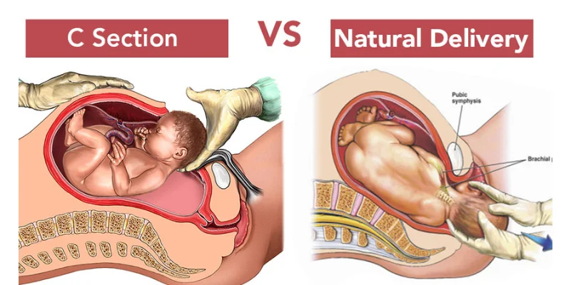 normal, delivery, section, expecting, Surekha Nursing Home, Korutla